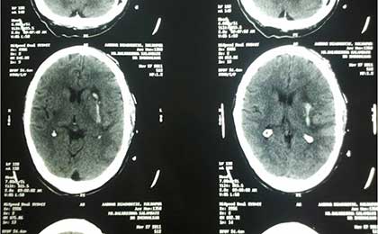 Intracerebral Haematoma
