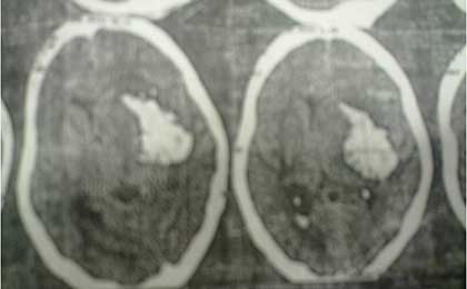 Intracerebral Haematoma
