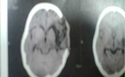 Intracerebral Haematoma
