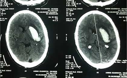 Intracerebral Haematoma