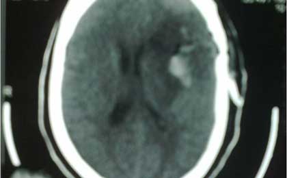 Intracerebral Haematoma