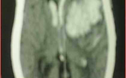 Intracerebral Haematoma