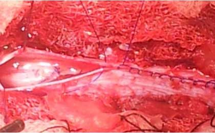 Intramedullary Tumor of Spine