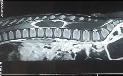 Intramedullary Tumor of Spine