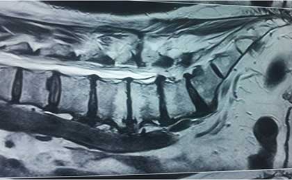 Lumbar Disc