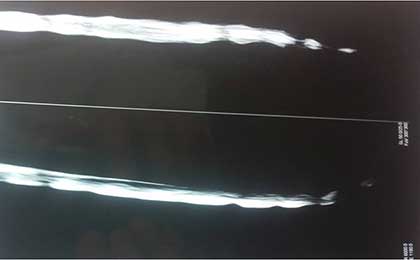 Lumbar Disc