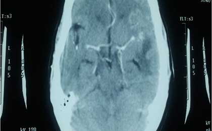 Meningioma of Brain