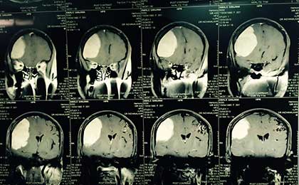 Meningioma of Brain