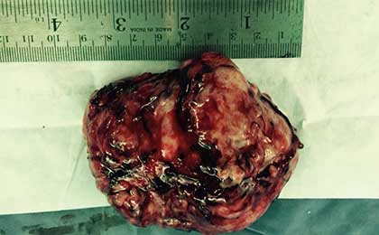 Meningioma of Brain