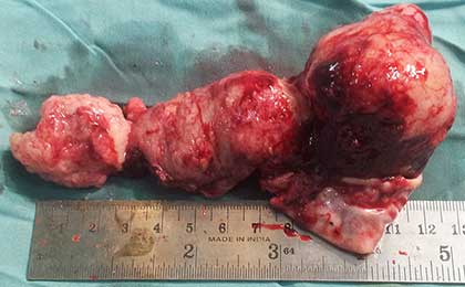 Meningioma of Brain