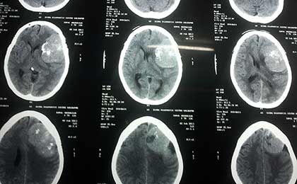 Meningioma of Brain
