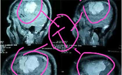 Meningioma of Brain
