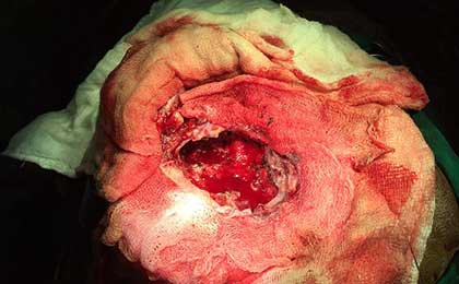 Meningioma of Brain