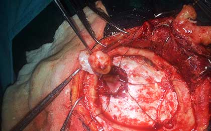 Meningioma of Brain