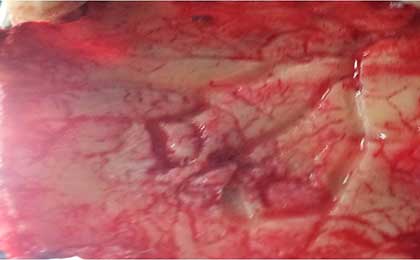Meningioma of Brain