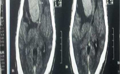 Meningioma of Brain