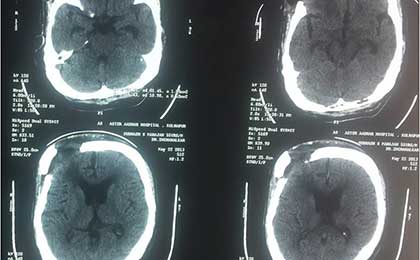 Meningioma of Brain