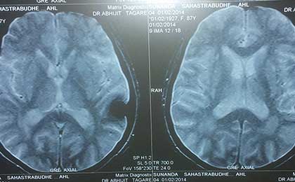 Meningioma of Brain