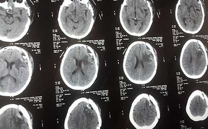 Meningioma of Brain