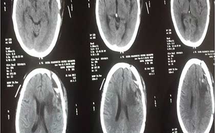Meningioma of Brain