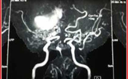 Meningioma of Brain