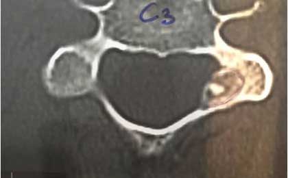 Osteoid Osteoma Paraspinal