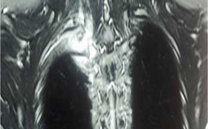 Osteoid Osteoma Paraspinal