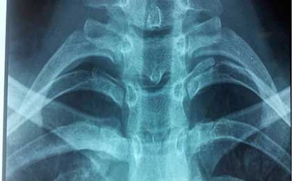 Osteoid Osteoma Paraspinal