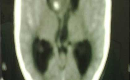 Paediatric Brain Tumors