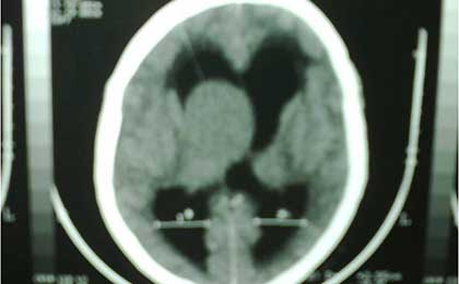 Paediatric Brain Tumors