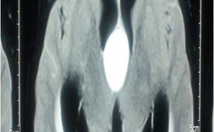 Paediatric Brain Tumors