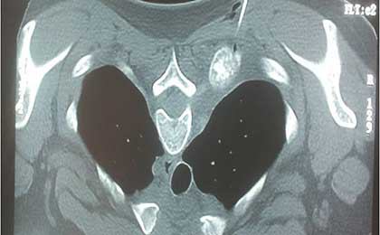 Percutanous Spine Procedures