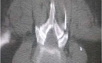 Percutanous Spine Procedures