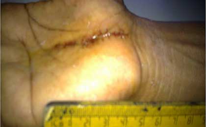 Peripheral Nerve Tumor