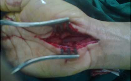 Peripheral Nerve Tumor