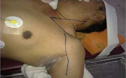 Peripheral Nerve Tumor