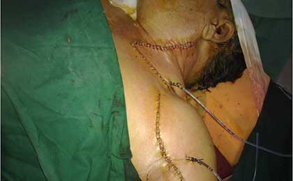 Peripheral Nerve Tumor