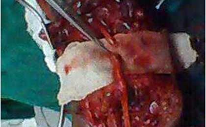 Peripheral Nerve Tumor