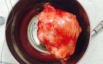 Peripheral Nerve Tumor