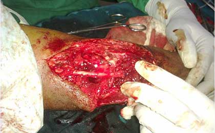 Peripheral Nerve Tumor