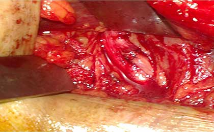 Peripheral Nerve Tumor