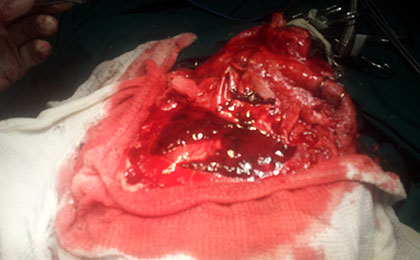 Subdural Haematoma