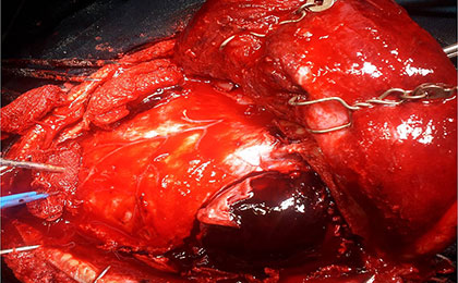 Subdural Haematoma