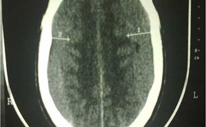 Subdural Haematoma
