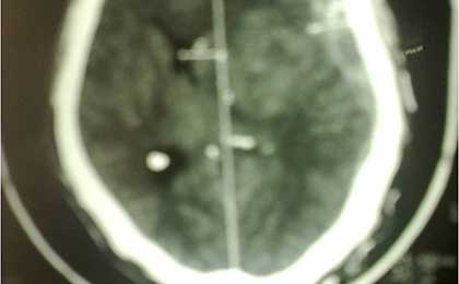 Subdural Haematoma