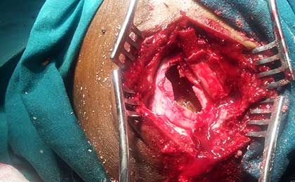 Subdural Haematoma
