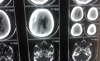 Subdural Haematoma