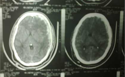 Subdural Haematoma