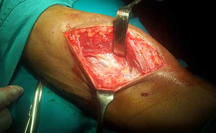 Supinator Syndrome