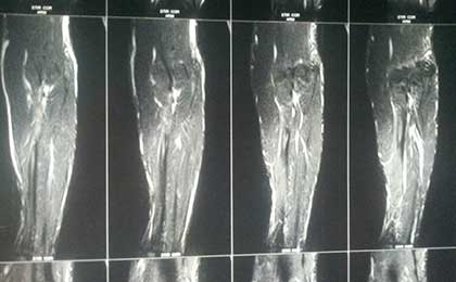 Supinator Syndrome